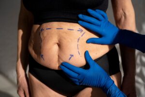Abdominoplasty is a cosmetic surgical procedure intended to make the abdomen thinner and firmer. It typically addresses excess skin and fat and may tighten the abdominal wall muscles to improve contour.