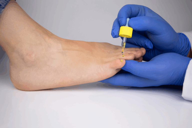 Onychomycosis treatment in Colombia