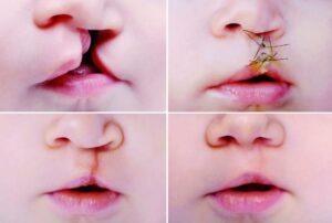 Cleft lip and palate care in Colombia combines skilled surgeons, multidisciplinary teams, and strong patient support networks. Find out what to expect from surgery, recovery, and long-term outcomes.